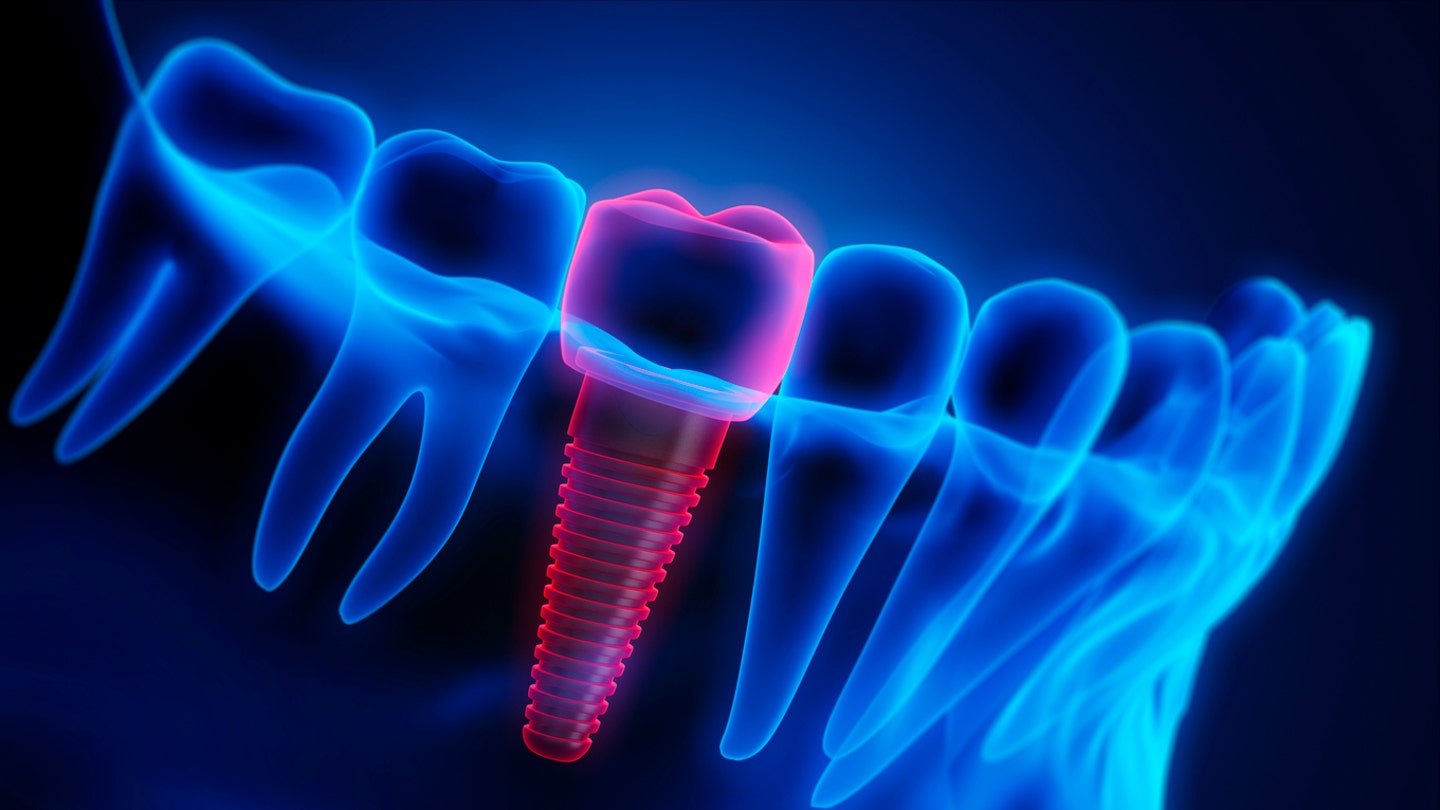Inteligența artificială poate genera coroane dentare personalizate în câteva secunde. Care sunt avantajele și riscurile