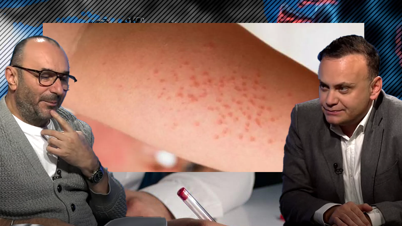Adrian Marinescu: „La Institutul Matei Balș avem foarte multe cazuri de rujeolă. Poate fi prevenită ușor, prin vaccinare”