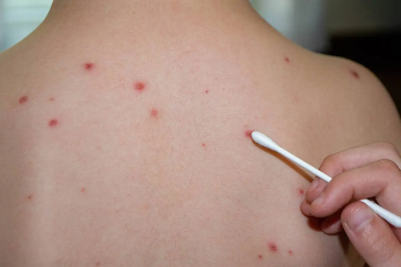 Focar de rujeolă într-o mare capitală din Europa. Peste 60 de copii infectați, medicii sunt în alertă