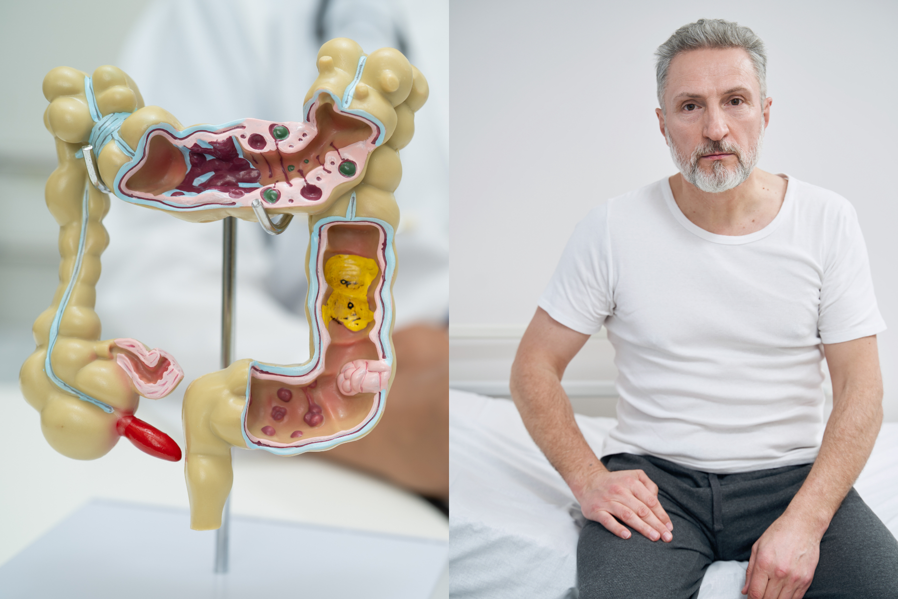 Cancerul de colon sub 50 de ani: o boală diferită?